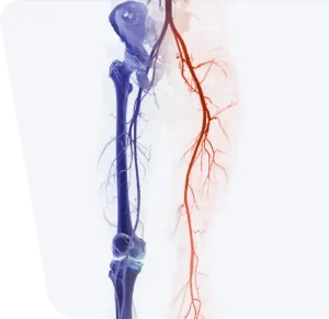 CTA artera femurală arată artera femurală pentru diagnosticarea bolii arteriale periferice acute sau cronice