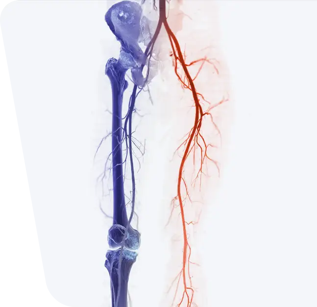 CTA artera femurală arată artera femurală pentru diagnosticarea bolii arteriale periferice acute sau cronice