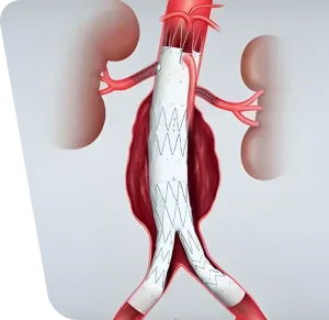 Poza ilustreaza o procedura EVAR pentru anevrismul aortic