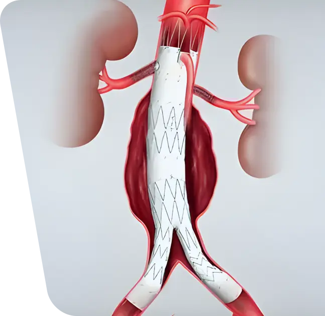 Poza ilustreaza o procedura EVAR pentru anevrismul aortic