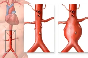 Imaginea ilustrează un anevrism aortic, inclusiv anevrismul aortic abdominal, evidențiind zona abdominală a unei figuri umane pentru a indica locația anevrismului.