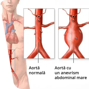 Imaginea ilustrează un anevrism aortic, inclusiv anevrismul aortic abdominal, evidențiind zona abdominală a unei figuri umane pentru a indica locația anevrismului.