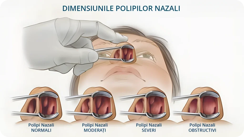 Desen care detaliaza dimensiunile la care pot ajunge polipii nazali netratati