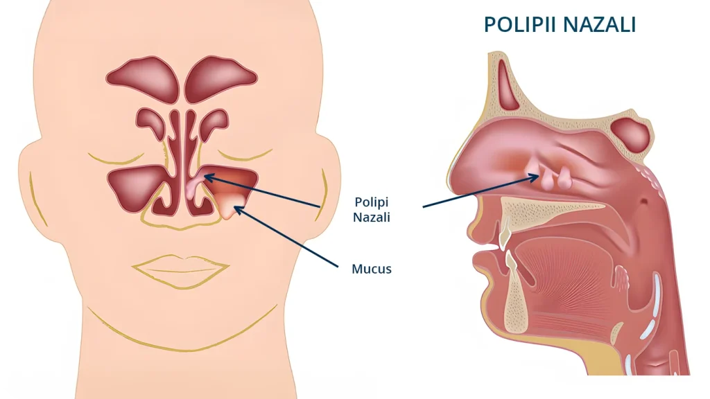 Desen care detaliaza cum arata polipii nazali