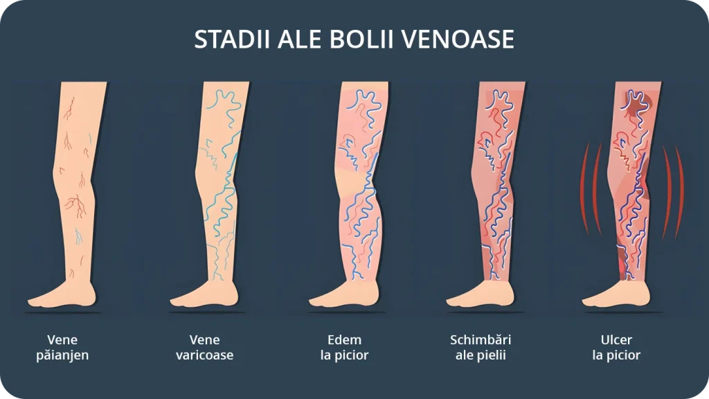 Poze ulcer varicos, etapele bolii venoase