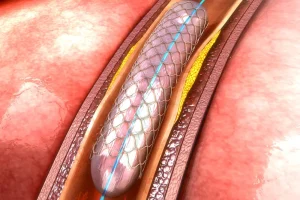 Poza reprezentativa cu angioplastia arterelor subclavii.