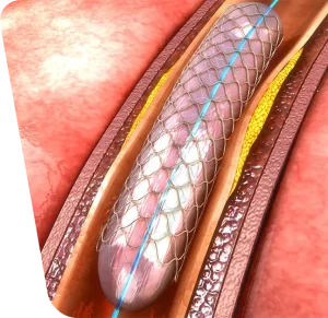 Poza reprezentativa cu angioplastia arterelor subclavii.