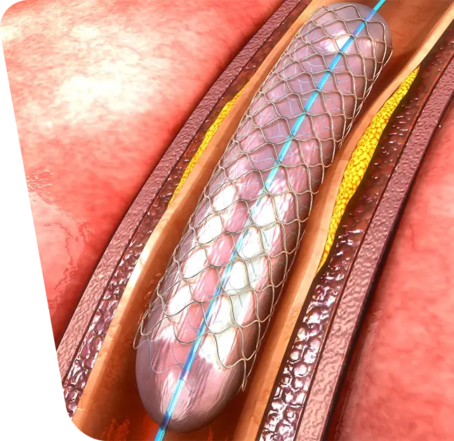 Poza reprezentativa cu angioplastia arterelor subclavii.