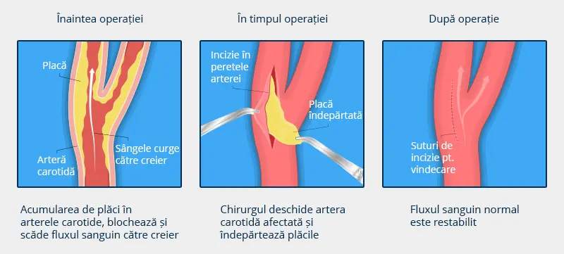 Poza care reprezinta procesul chirurgical pentru endarterectomie carotidiana, inainte de operatie, in timpul operatiei si dupa operatie.