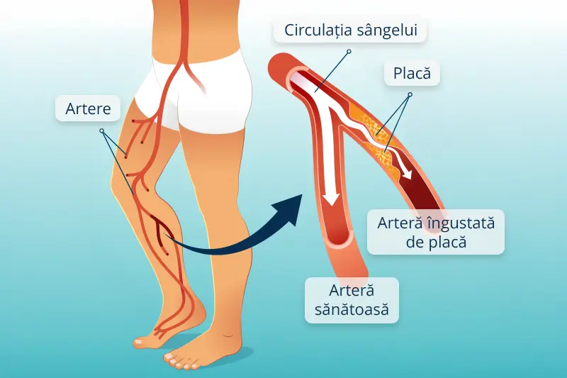 Poza reprezentativa cu circuitul arterelor la nivelul picioarelor - Boala Arteriala Periferica