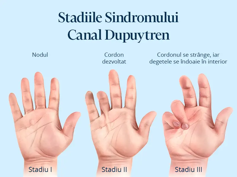 Poza afiseaza stadiile pentru contractura Dupuytren. boala dupuytren poze.